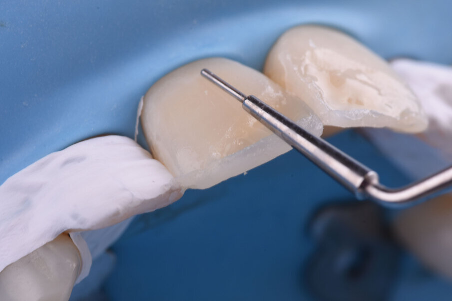 Sl. 11: Uklanjanje viška dentinske mase  i obezbeđivanje prostora za gleđnu masu