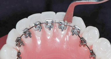 Curso de  Ortodoncia Lingual: El Método Directo 2D: Fácil y Asequible