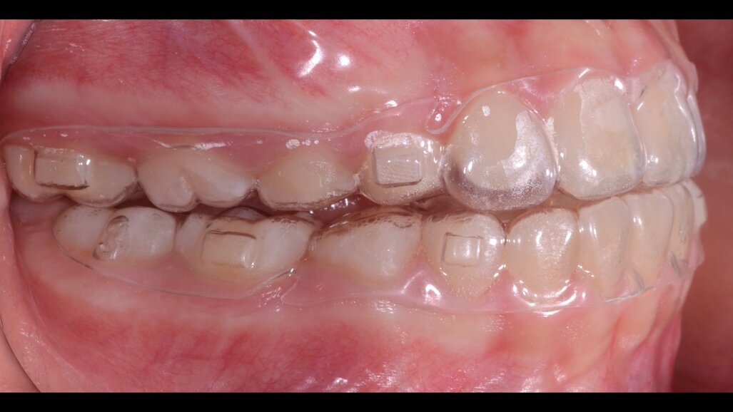 F22 Young, un dispositivo estetico funzionale per il trattamento dei pazienti in crescita con malocclusione di classe II: Case Report