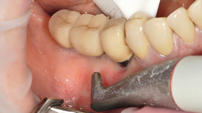 Prévention 0 : La meilleure façon de prévenir la péri-implantite ?