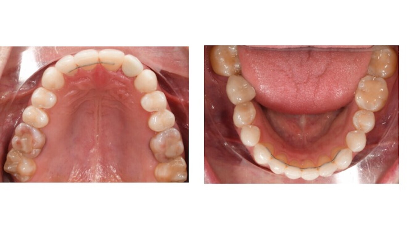 Figs. 13a & b: Final occlusal photographs.