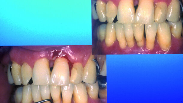 Die 2-Schritt-Therapie bei schwerer Parodontitis