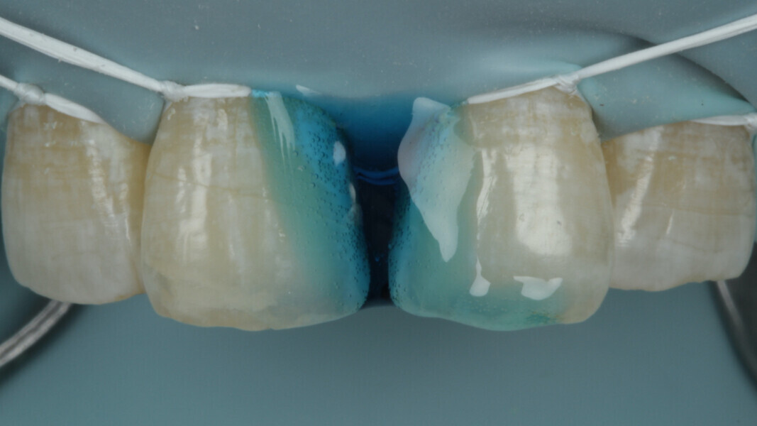 Fig 8. 37% Phosphoric acid was used to etch the enamel for 20 seconds and thoroughly washed after that.