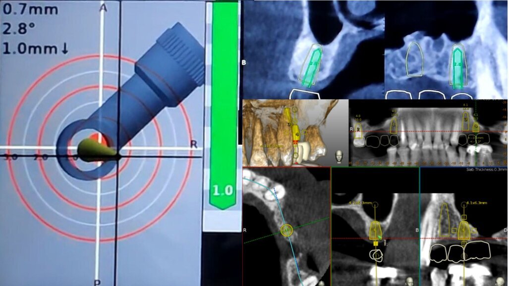 Study shows dynamic navigation superiority in complex maxillary implant cases