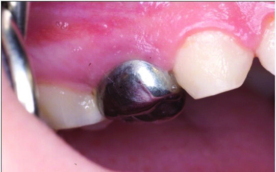 Figure 9: The Hall Technique: One week later. The SSC is level with the occlusion. There is no tightness, blanching or pain.