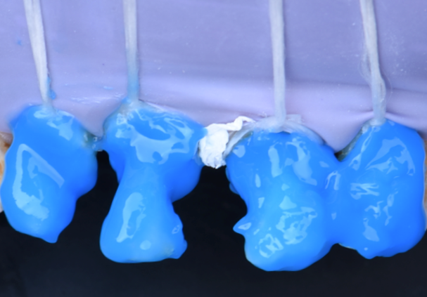 Step 4 – Etching  The etching protocol was done using  DeTrey® Conditioner 36 for 15s  then rinsed with water spray.  