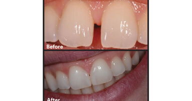 Midline diastema closure using  the front wing technique