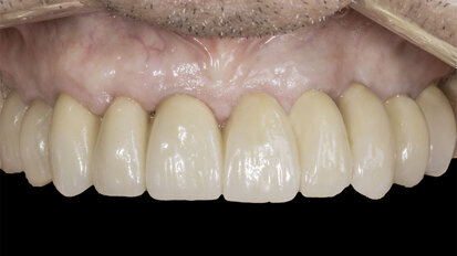 Implant maintenance care solution