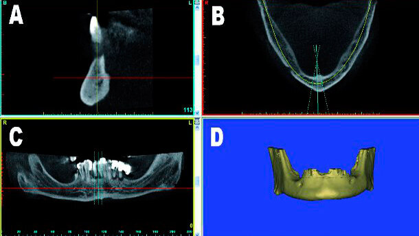 Guida alla riduzione ossea: concetti di pianificazione virtuale in 3D per protesi mandibolare full-arch su impianti
