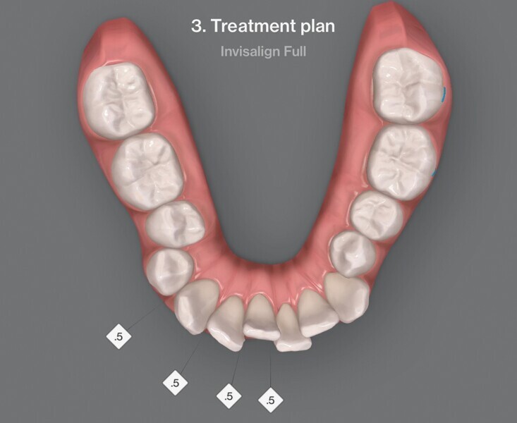 Fig. 4b : Premier résultat prévu par simulation ClinCheck.