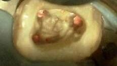 Nowatorska metoda wypełniania kanałów – technika dopasowanego pojedynczego ćwieka gutaperkowego z określonym stopniem rozbieżności