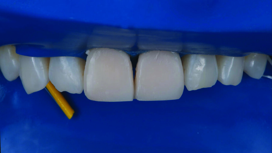 Restorations after polishing using the 3M™ Sof-Lex™ Diamond Polishing System.