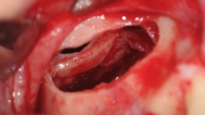 Rialzo di seno mascellare mediante utilizzo di osso eterologo corticomidollare collagenato