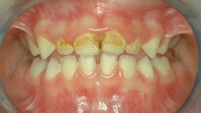 טיפול בסילבר-דיאמין-פלואוריד – לטיפול בנגעי עששת בילדים