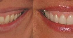 Dvofazno estetsko produženje kliničke krunice zuba