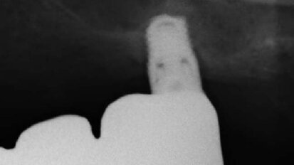 Restauro di un settore postero-superiore atrofico con impianti extracorti