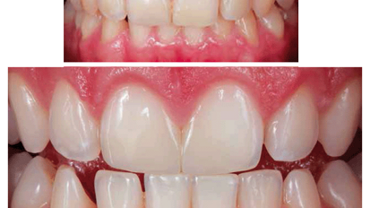 Restauraciones estéticas en la clínica diaria