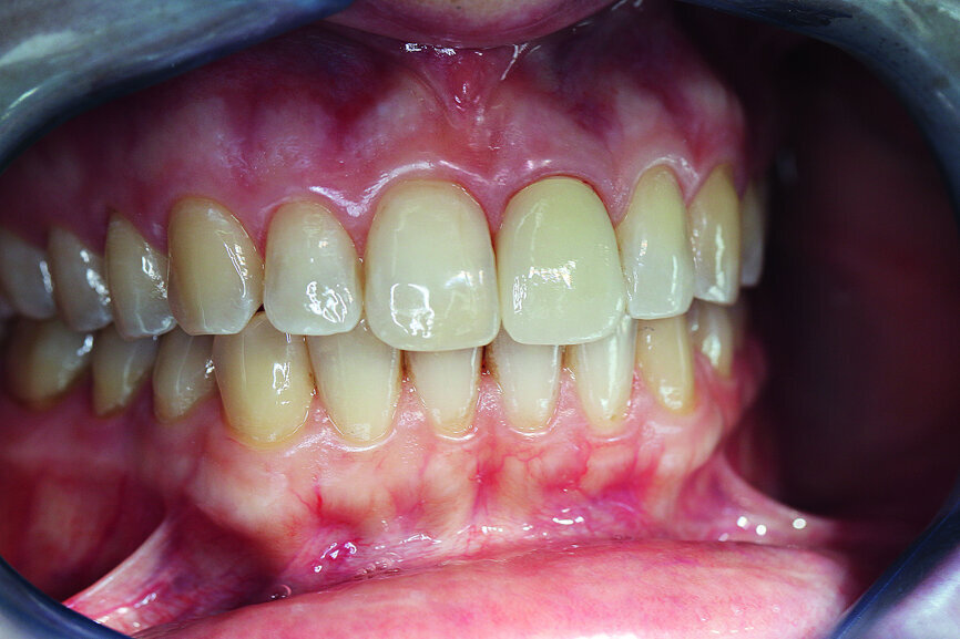 Fig. 18: Final image immediately after inserting the crown with an ideal red–white aesthetic.