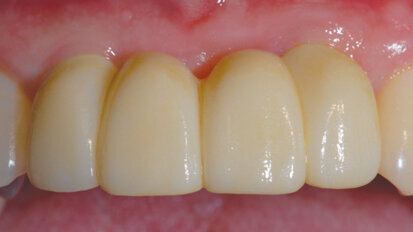 From intraoral scan to final custom implant restoration From intraoral scan to final custom implant restoration