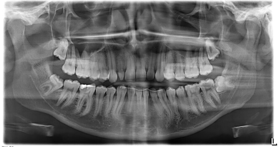 Fig. 1_Ortopanoramica iniziale.