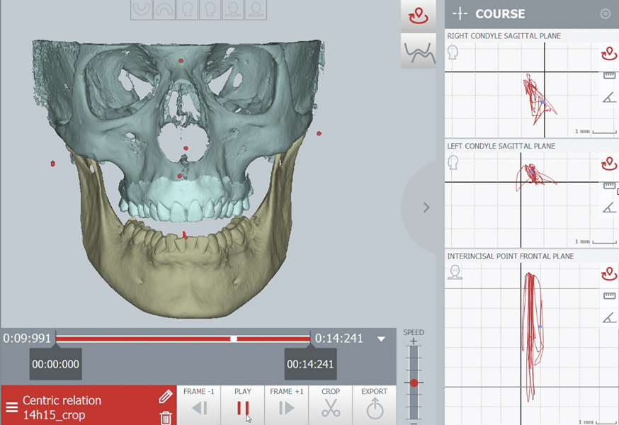 Fig. 38: Pretreatment condylar and incisor graph recordings of the arc of closure.