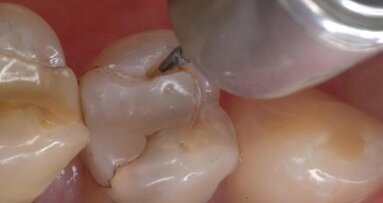 The perimeter preparation