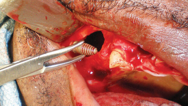 Implants displaced into the maxillary sinus