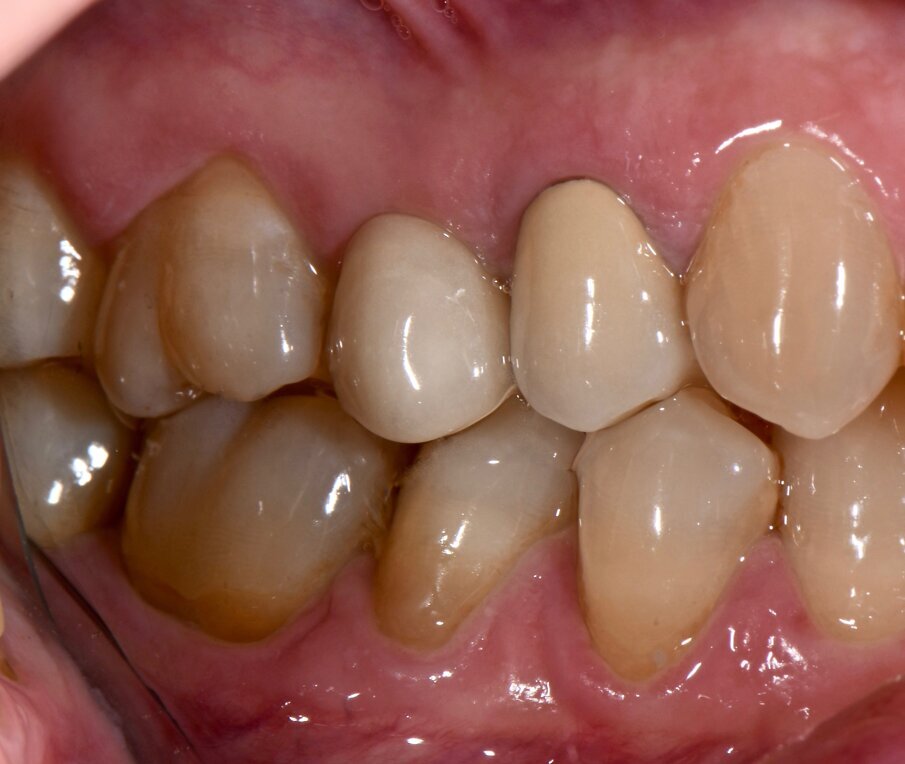Fig. 1b - Condizione clinica al baseline: I e VI sestante.