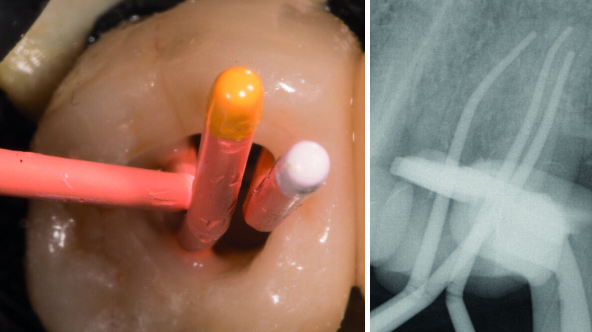 Considérations sur une restauration optimale des dents perforées