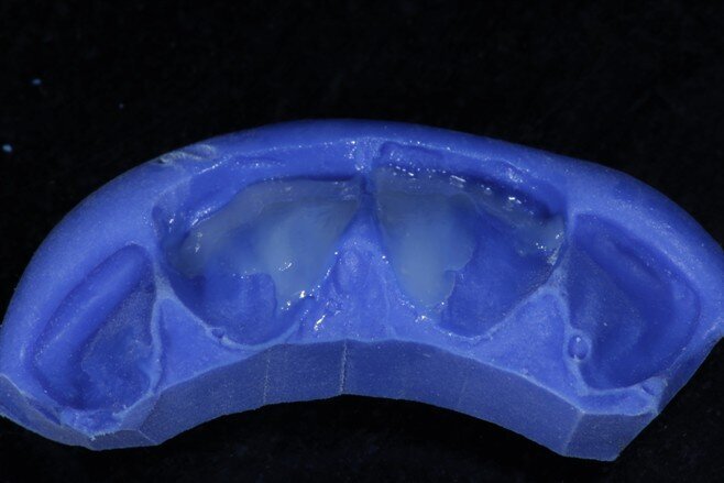 Fig 6 Enamel shade for palatal shell on putty index