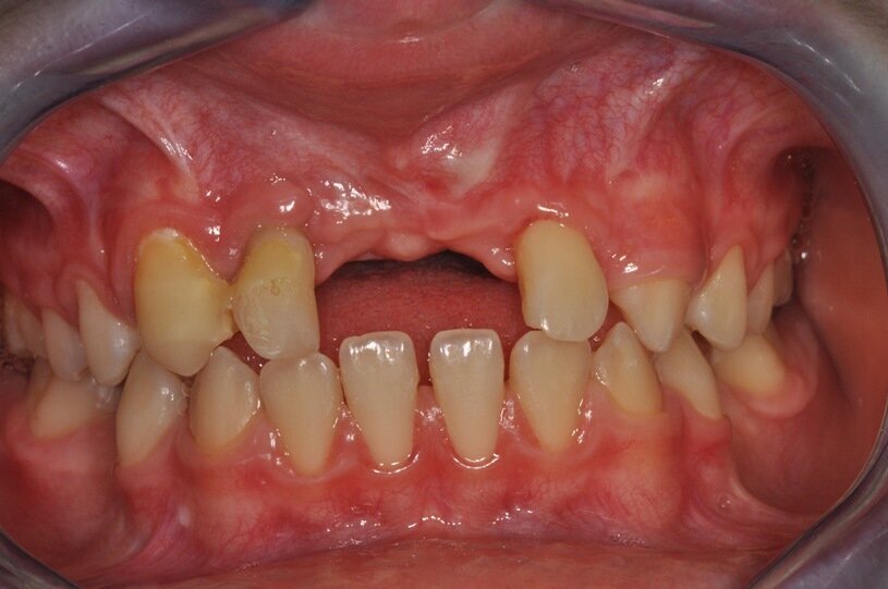 Ryc. 11_Stan miejscowy 6 miesięcy po zabiegu.