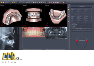 Polorto – DDP-Ortho Software