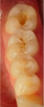 Fig. 4: The cavity after preparation.