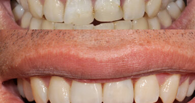 Las ventajas de la restauración con un sistema de color inteligente