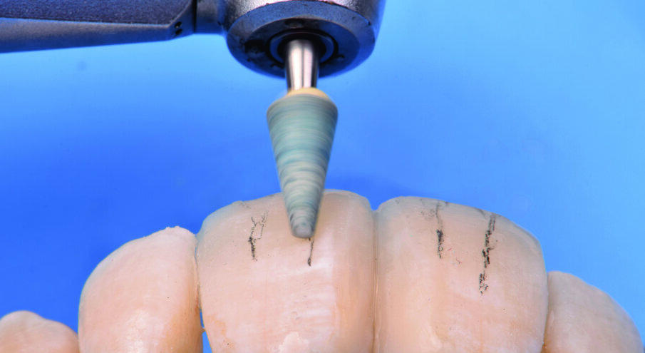 Fig 18. Smoothening of the labial grooves with Dura Green Stone