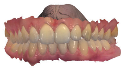 Malokluze I. třídy léčená pomocí F22 Aligners