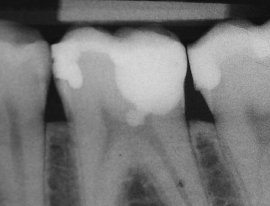 Fig. 1e: (a) Deep carious lesion. (b) Partial pulpotomy. (c) MTA application with the MAP System and PD MTA White. (d) Filling. (e) Post-op radiograph showing the pulp capping with MTA.