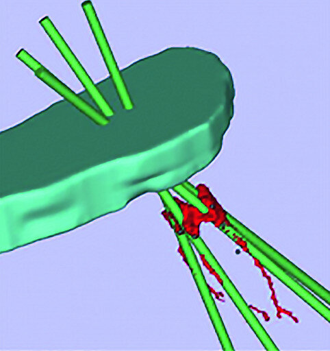 Figs. 11a–c : Depuis la gauche : plan de traitement virtuel pour un accès endodontique guidé par scanner (CT-GEA). La dent à traiter est segmentée par le scanner volumique, des trajets d’accès idéaux sont tracés au travers de la face occlusale de la dent, et un guide de forage CT-GEA est imprimé en 3D.