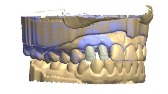 Odwzorowanie profilu wyłaniania implantu przy pomocy skanera wewnątrzustnego
