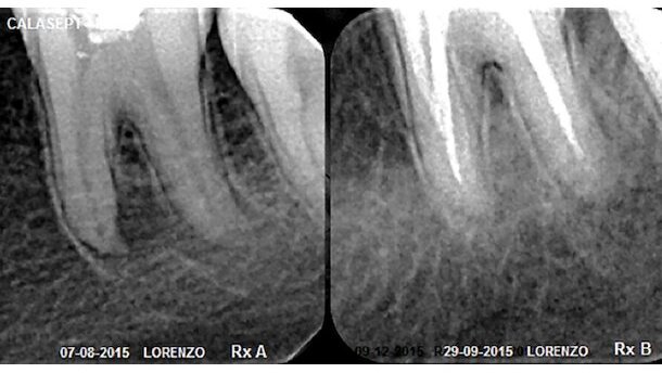 Tratamiento de procesos periapicales con hidróxido de calcio en alta concentración