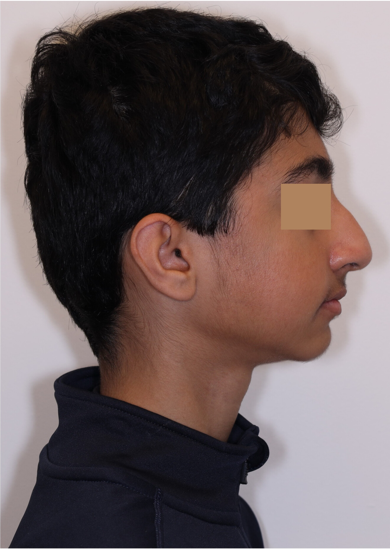 Figs. 5a–c: Extra-oral photographs after the first phase of treatment.