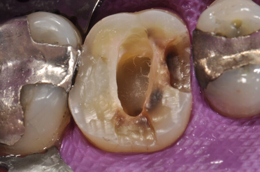 Fig. 3: Extracción de las obturaciones anteriores y reducción de las cúspides.