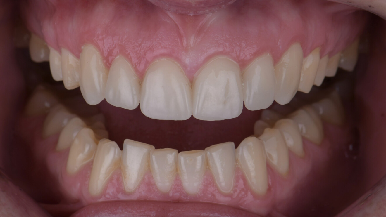 Fig. 8a: Two-week follow-up of the six maxillary anterior veneers. Intra-oral frontal view with the teeth apart.