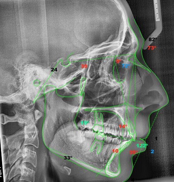 Fig. 19: Steiner cephalometric analysis after the orthodontic treatment (image generated using NemoCeph Studio).