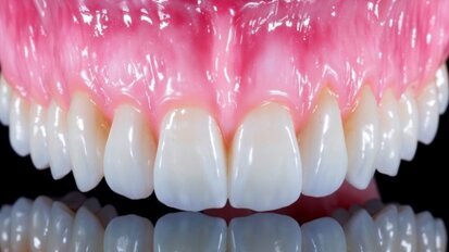 Korony pełnokonturowe – prosty i szybki sposób wykonywania estetycznych prac ceramicznych