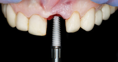Are copycat brands putting pressure on the dental implant industry in Latin America?