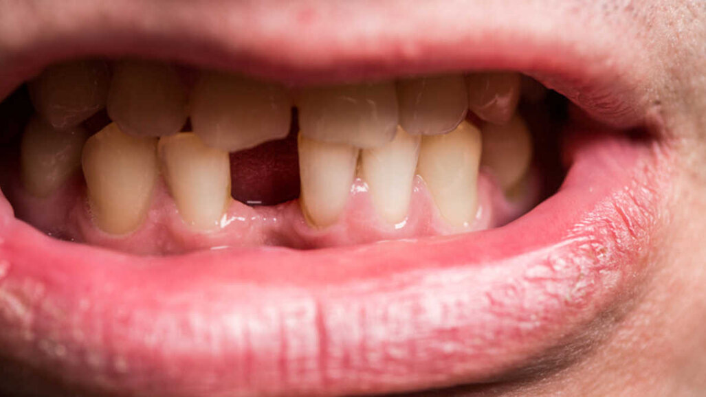 Zaprzestanie palenia może zmniejszyć ryzyko utraty zębów