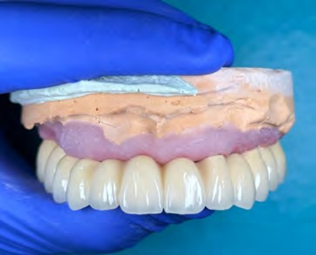 Fig. 3b: Lateral view of the definitive maxillary implant-supported prosthesis prior to  insertion.