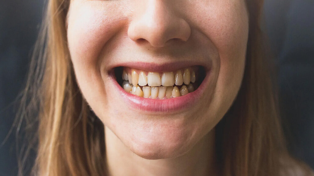 Experts warn of rising tooth damage linked to Ozempic use