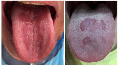 Manifestaciones orales más comunes de Covid-19